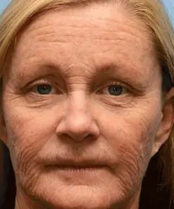 Pureluxo® Botox Bee Venom Wrinkle Removal Cream